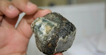 Safra Kesesi Taşı Belirtileri ve Tedavisi Safra Kesesi Taşı Belirtileri ve Tedavisi