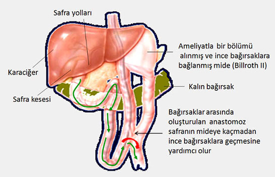 Midede Safra Suyu Belirtileri ve Tedavisi