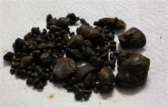 Safra Kesesi Kumu Belirtileri ve Tedavisi